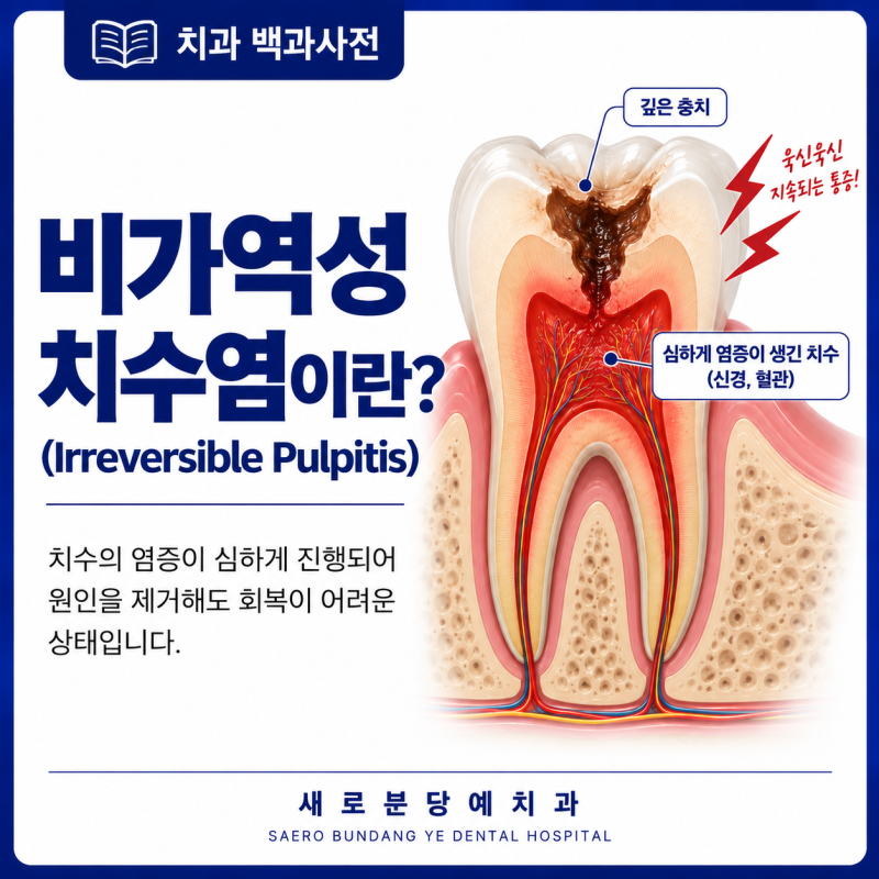 비가역성 치수염(Irreversible Pulpitis)이란?
