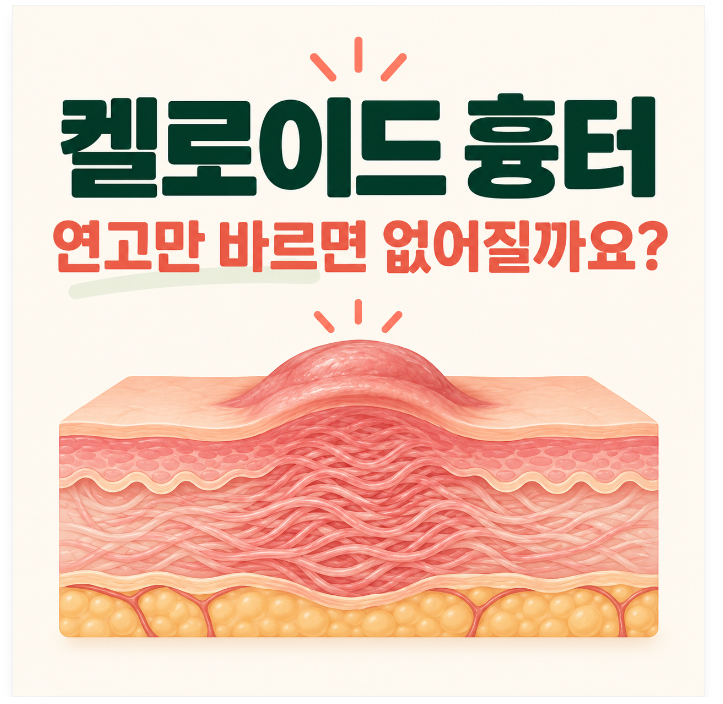 켈로이드 흉터, 흉터 연고만 바르면 없어질까요?