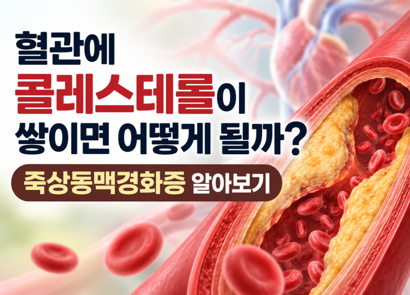 혈관에 콜레스테롤이 쌓이면 어떻게 될까? 죽상동맥경화증 알아보기