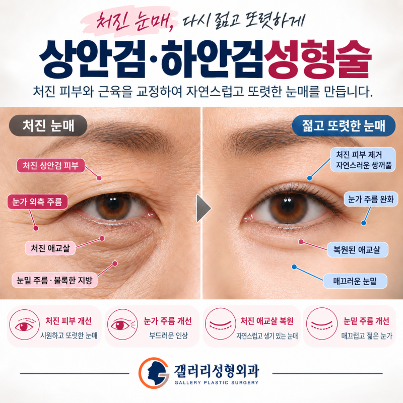 대전 상안검·하안검 후기｜처진 눈과 눈밑 주름, 애교살까지 자연스럽게 개선한 실제 사례