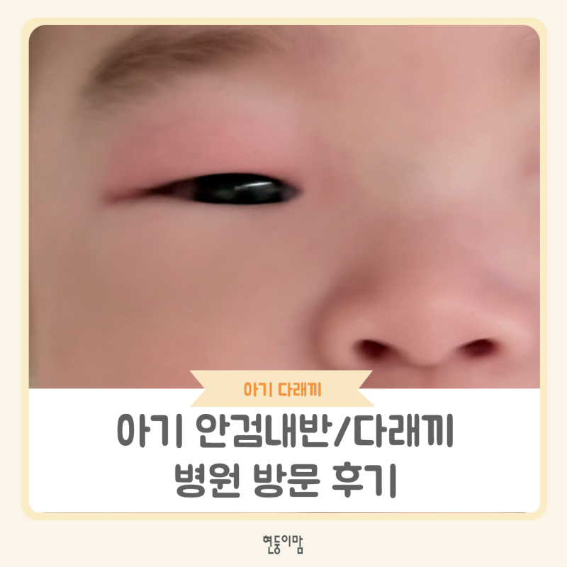 신생아 아기 다래끼 안검내반 결막염 병원 다녀온 후기(토라신 안약/안연고)