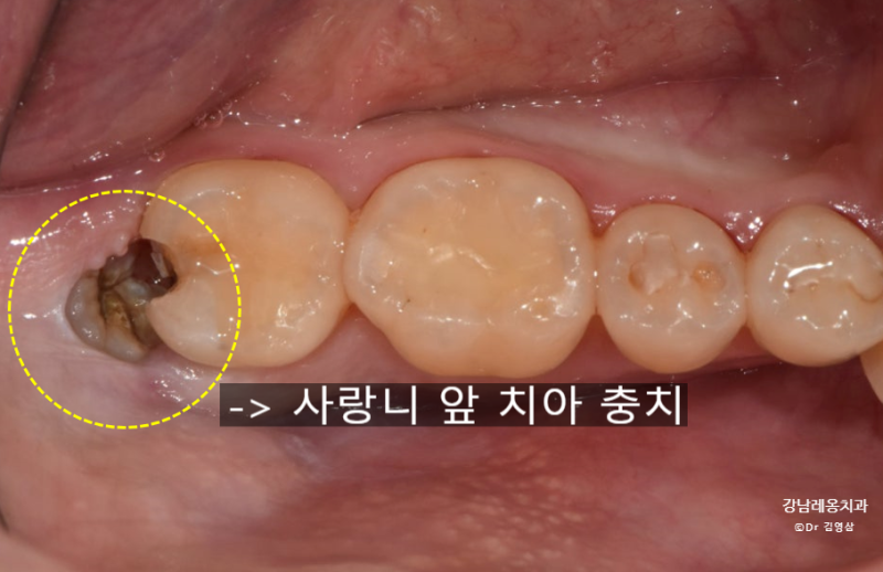사랑니와 맞닿은 어금니 충치 / 사랑니 음식물 끼임, 그냥 방치했더니 앞 치아까지 신경치료....
