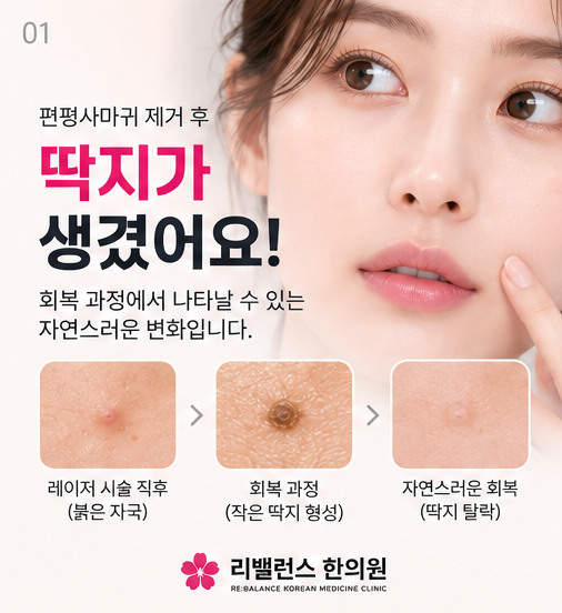 편평사마귀 제거 후 딱지는 언제 떨어질까요?