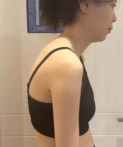 허리디스크파열 수핵이 터져 나와 심한 다리 저림이 생길 때