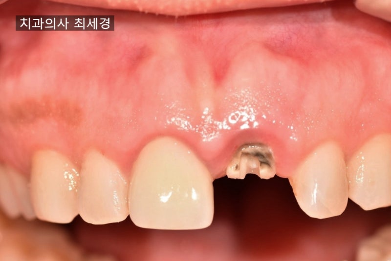 30대 앞니 임플란트 가격, 기간, 과정에 대한 글