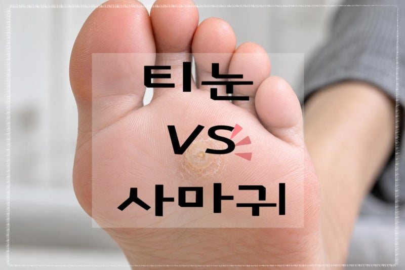 발바닥 티눈 그냥 뜯어도 될까? 사마귀와 차이·제거·치료 총정리