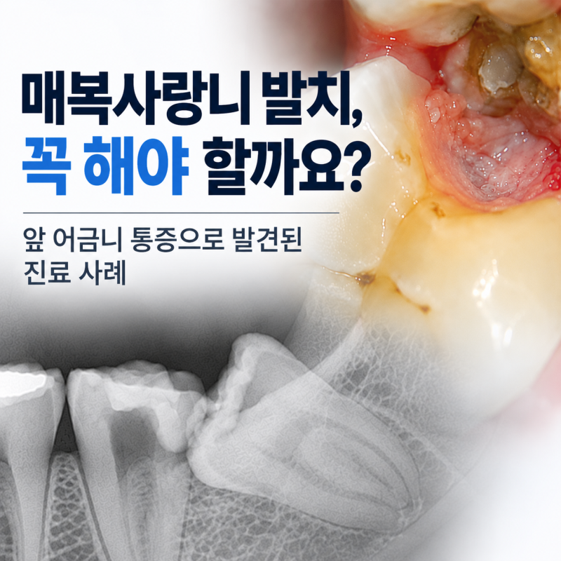 매복사랑니 발치, 꼭 해야 할까요? ｜앞 어금니 통증으로 발견된 진료 사례
