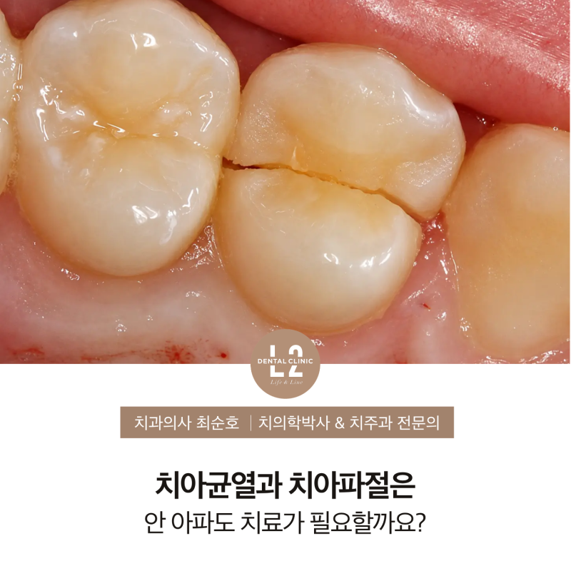치아균열과 치아파절은 안 아파도 치료가 필요할까요?