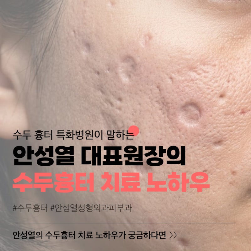 강남 패인 수두 흉터 제거 치료 수술 안성열성형외과피부과