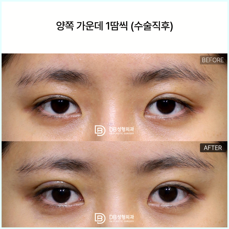 쌍수후짝눈 스트레스, 한쪽만 재수술한다고 대칭이 맞을까?