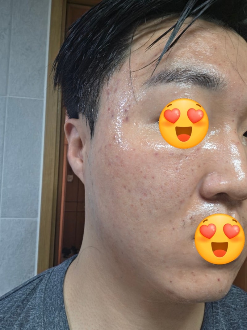 피부과 잔주름, 흉터에 좋은 포텐자, 리투오 손주사 후 홈케어하기(feat,토리든 밸런스풀 시카....
