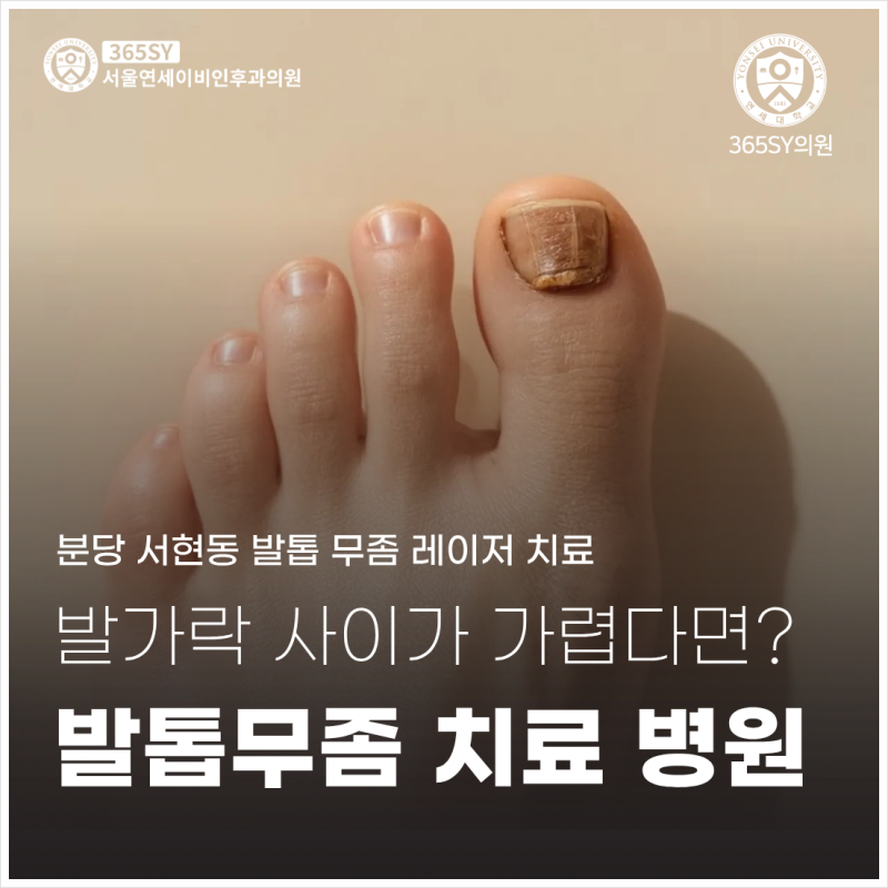 서현역 발톱무좀 치료 병원｜발가락 사이가 자꾸 가렵다면?
