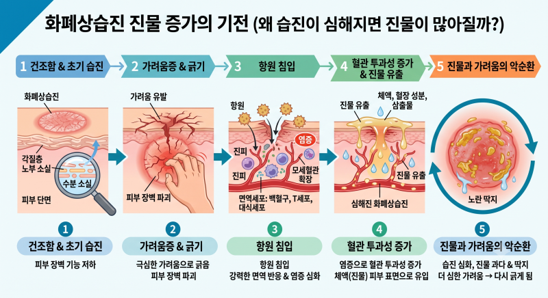 화폐상습진 진물 멈추는 방법, 종류에 따라 다릅니다.