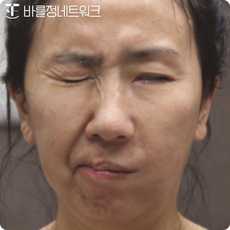 구안와사 침치료 10회로 낫는 사람, 30회 걸리는 사람 무슨 차이일까요?