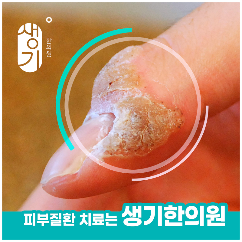 편평사마귀 연고 발라도 그대로라면, 콜린성두드러기 돌기와 헷갈리고 있는 건 아닐까요