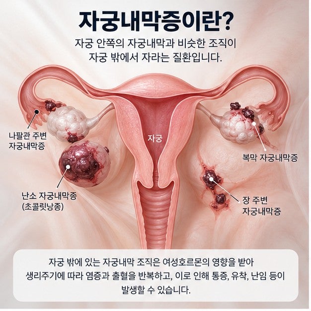 자궁내막증 증상, 원인, 치료, 임신, 심한 생리통 등 총정리