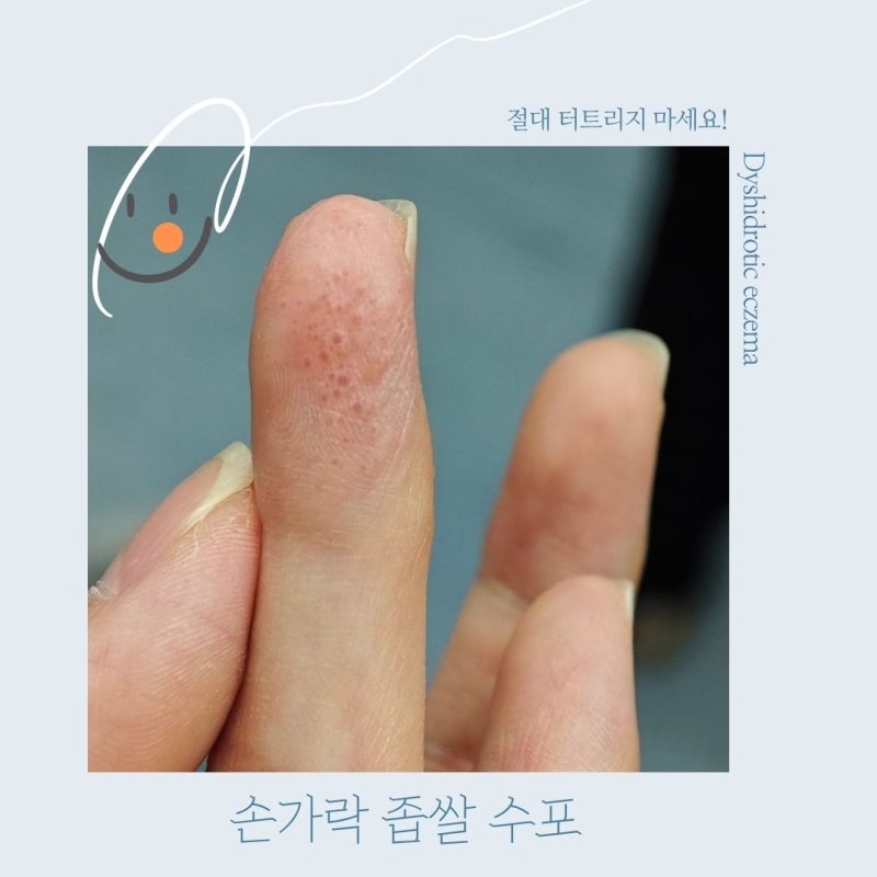 손가락 수포 원인부터 한포진 관리까지, 작은 물집이 생겼다면
