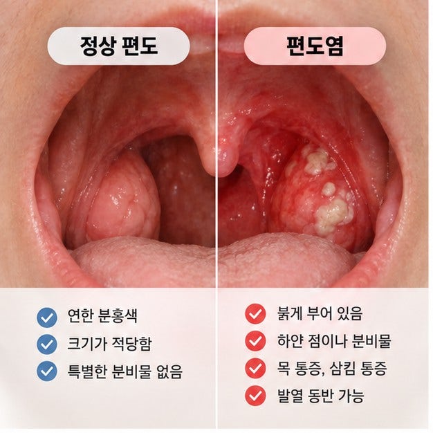 편도염 증상, 원인, 치료, 목 아플 때, 편도 부음, 고열, 항생제, 전염 등 총정리