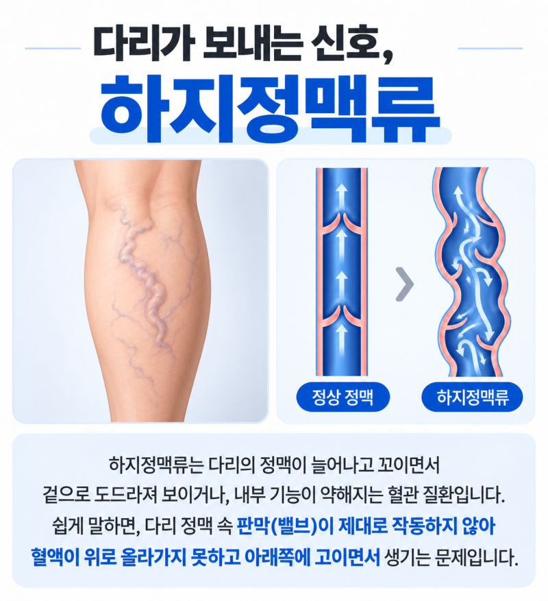 물리치료사가 알려주는 하지정맥류 총정리
