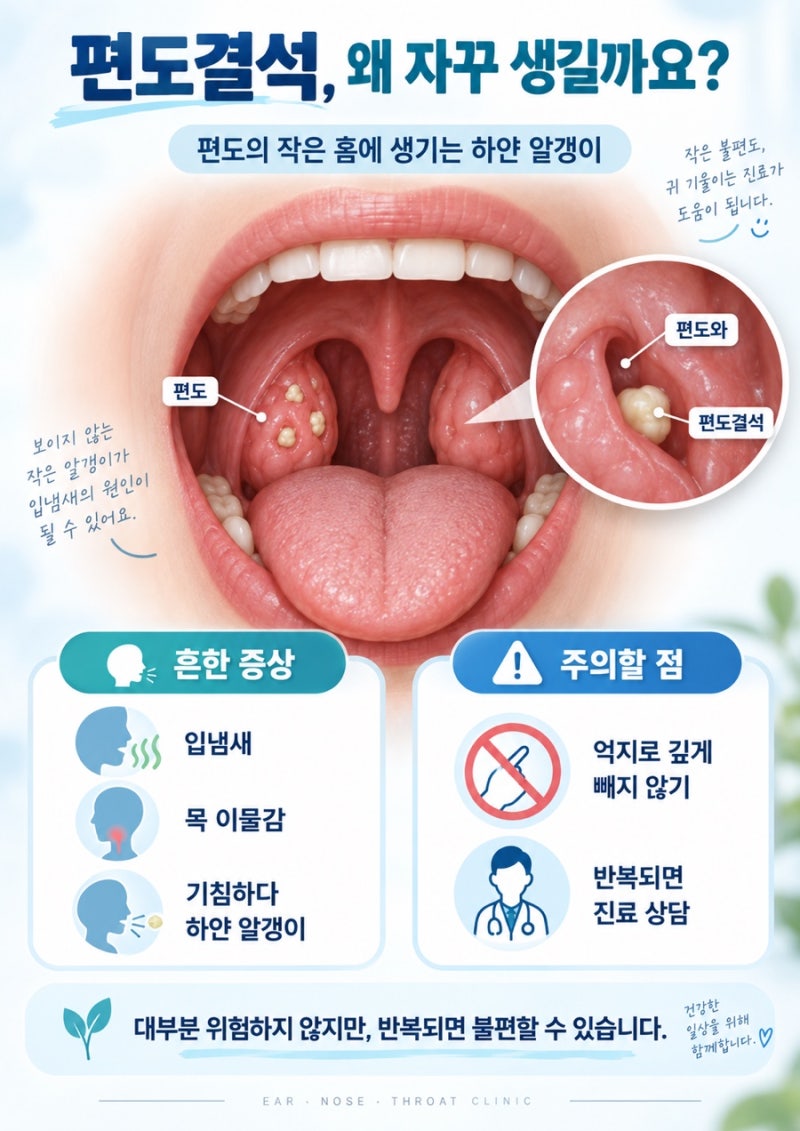 편도결석, 왜 자꾸 생길까요? 직접 빼도 될까?