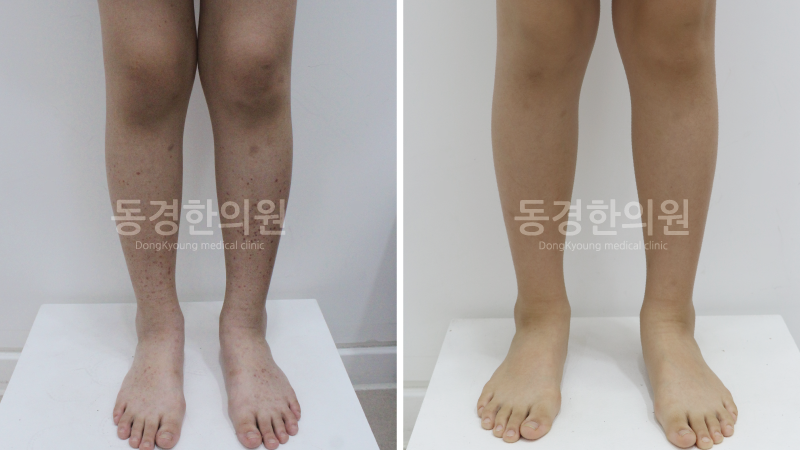 자반증 초기 증상 원인과 치료방법, 자반증 자연치유 안됩니다.