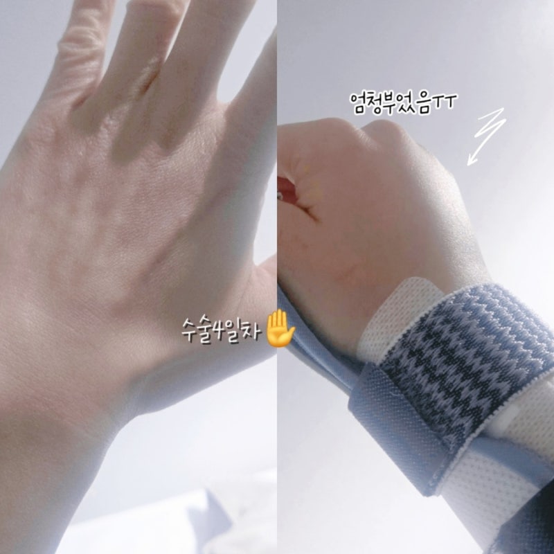 드퀘르벵 수술 5개월 후기 일상생활과 운동은 언제부터 했는지까지 수술후 회복후기