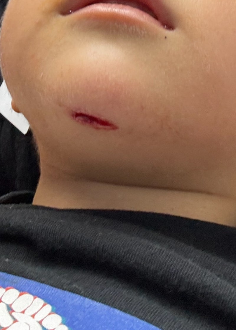 4살 아이 턱 찢어짐, 부분마취로 성형외과 봉합 후기와 보험 청구