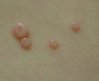 대전물사마귀치료) 아이 물사마귀, 가만히 놔둬도 사라질까? 아니면 꼭 치료받아야 할까?
