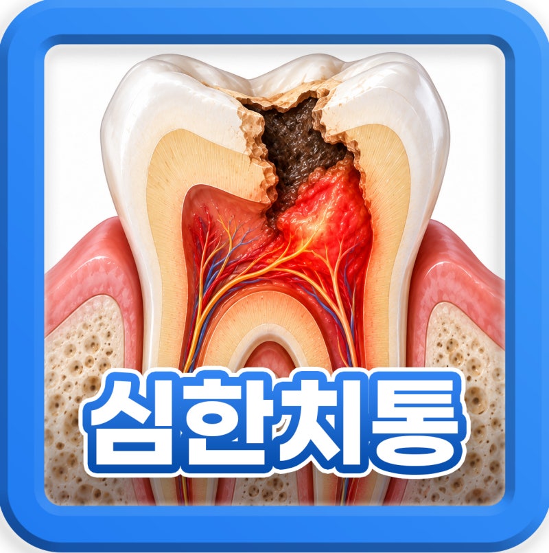 급성 치수염 심한 치통 방사통 통증 원인, 응급실 방문?