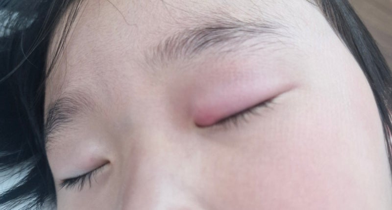 [아이 다래끼 수술 후기]결국 수술까지 했어요. 6살 아이 다래끼 치료부터 수술 후 관리까지