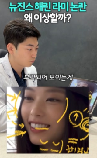 뉴진스 해린 치아 송곳니 라미네이트 사진 성형 전후