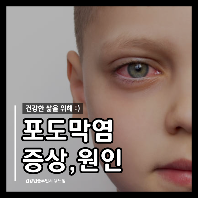 포도막염 증상 원인 치료 전염 완치