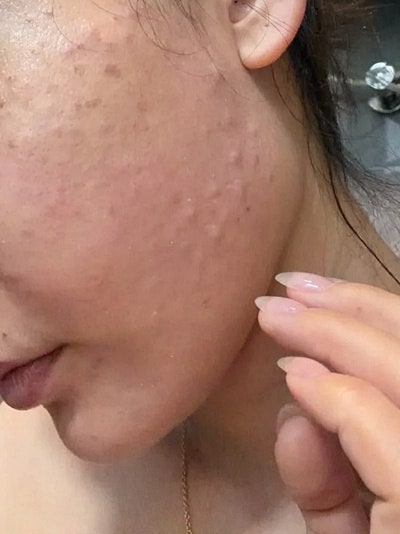 콜린성 두드러기 얼굴 가려움 심할 때 따라해보세요