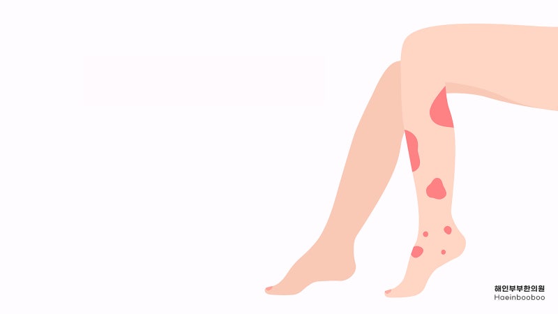 분당 알레르기 자반증은 왜 다리와 엉덩이에 잘 생길까요?