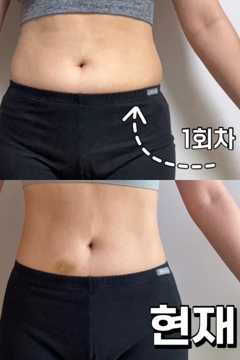 대전 다이어트병원 복부 지방분해주사 패키지 후기 뱃살 관리 가격 효과