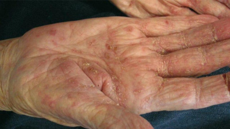 요양원에서 꼭 알아야 할 옴(Scabies)