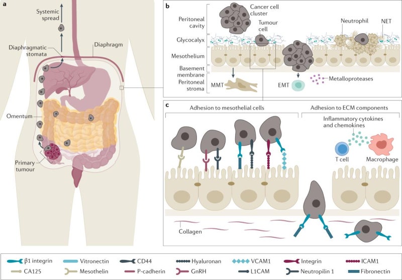 위암 복막전이(Peritoneal metastasis of gastric cancer)
