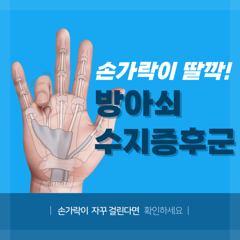 방아쇠수지증후군 원인 무엇일까? 반복되는 손가락 ‘딸깍’ 증상 주의