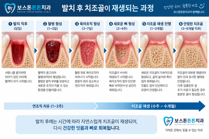 사랑니 발치 후 통증, ‘혈병’이 중요한 이유