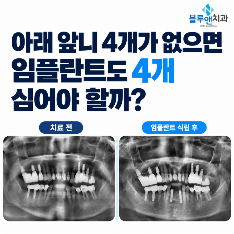 아래 앞니 4개가 없으면 임플란트도 4개 심어야 할까?