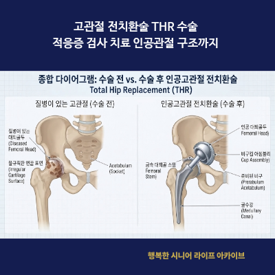 고관절 전치환술 THR 수술｜적응증 검사 치료 인공관절 구조까지