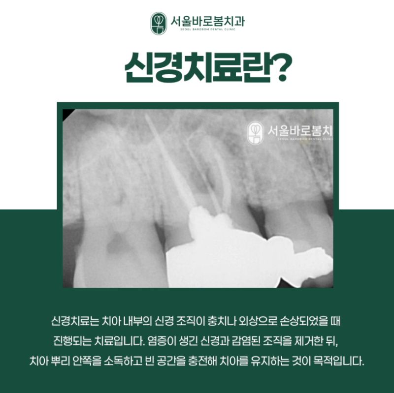 정왕동치과 신경치료 기간, 몇 번 받고 크라운은 언제 씌울까요?