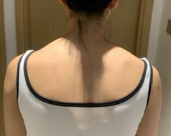 회전근개파열수술비용 병원별 어깨 힘줄 봉합술 부담금 비교 정리