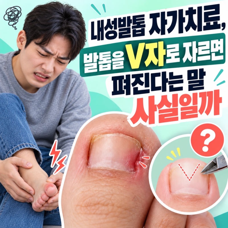 내성발톱 자가치료, 발톱을 V자로 자르면 펴진다는 말 사실일까