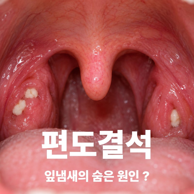 편도결석 원인은? 목에서 냄새나는 하얀 알갱이와 제거방법