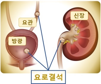 극심한 옆구리 통증, 요로결석 증상과 제거 방법 신장 요로결석 원인부터 여성 요로결석, 수....
