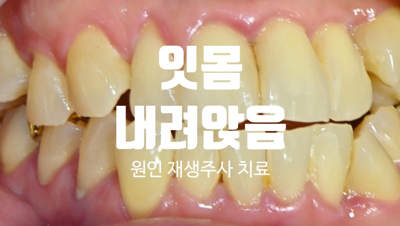 잇몸 내려앉음 원인, 약 재생주사 치료 가능할까?
