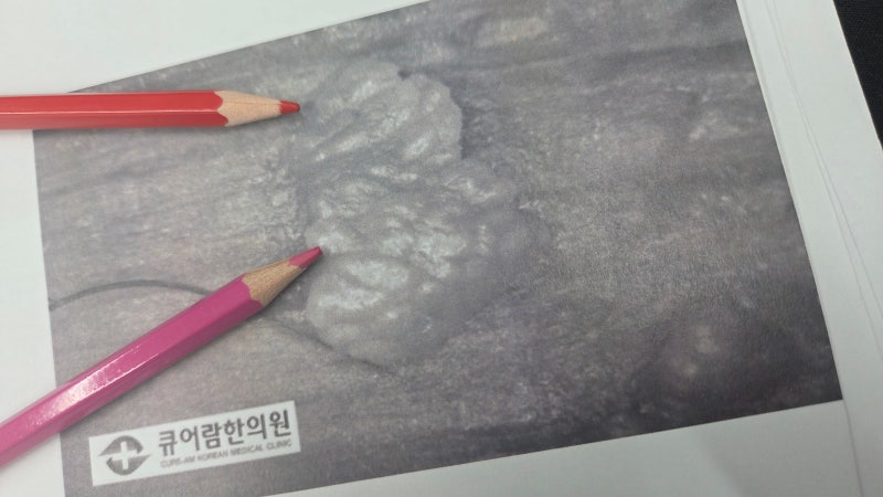 곤지름 사진 확인, 레이저 제거 깔끔하게 정리될까 고민된다고요?
