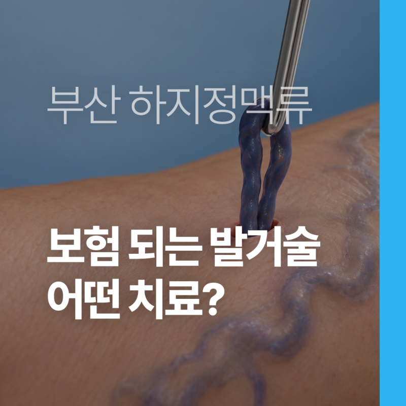 부산 하지정맥류 보험 되는 발거술, 어떤 수술인가요?