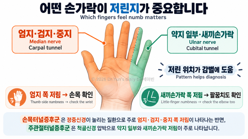 상지 통증 | 새끼손가락과 약지가 저리다면? 주관절터널증후군일까요?